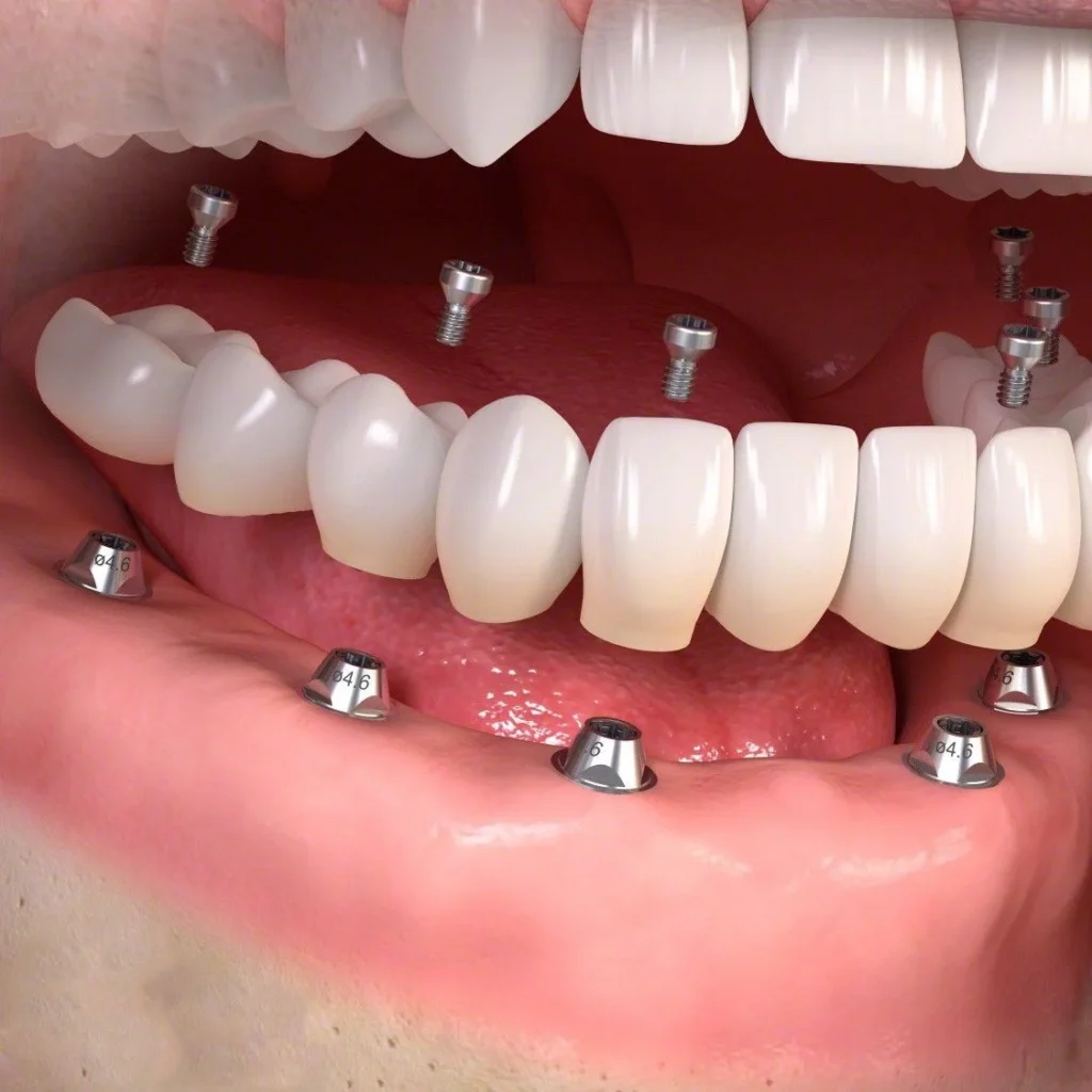 A imagem mostra uma simulação da aplicação de prótese dentária. A boca está aberta com ligas metálicas e os implantes sendo colocados. Tratamento oferecido pela  De Luca Ortodontia, Tijuca e Copacabana, Rio de Janeiro.