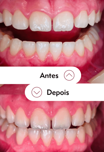 Antes e depois da gengivectomia estética para sorriso gengival na Tijuca no Rio