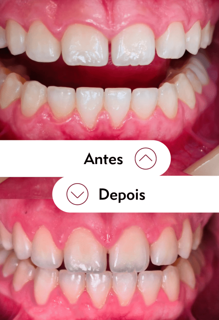 Antes e depois da gengivectomia estética para sorriso gengival na Tijuca no Rio